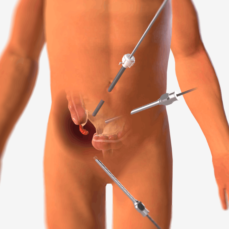 Λαπαροσκοπική Σκωληκοειδεκτομή Laparoscopic Appendectomy